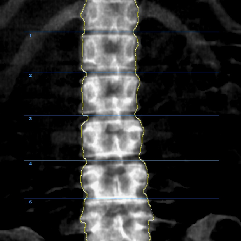 DXA Bone Densitometry